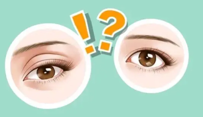 双眼皮手术要做多久